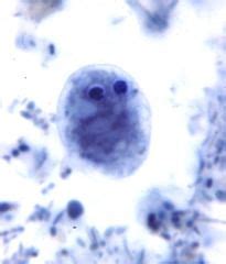  Dientamoeba Fragilis:  A Microscopic Stowaway That Might Be Lurking In Your Gut Right Now!